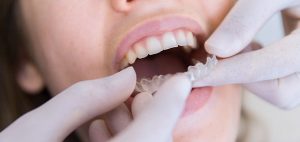 Hur sköter man om sina tandimplantat?